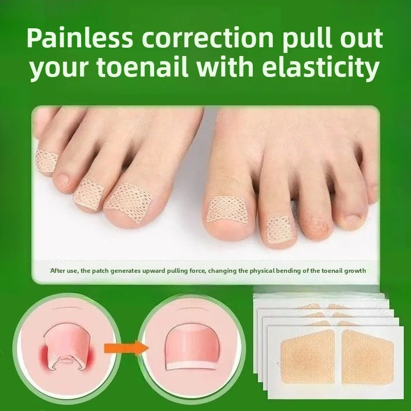 Adesivo para alívio de sulcos nas unhas dos pés